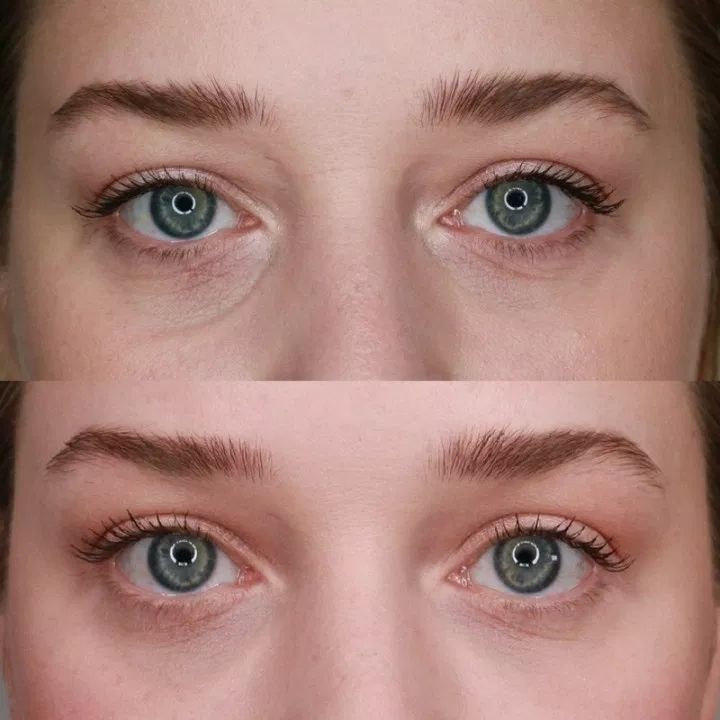 Parches bolsas ojos